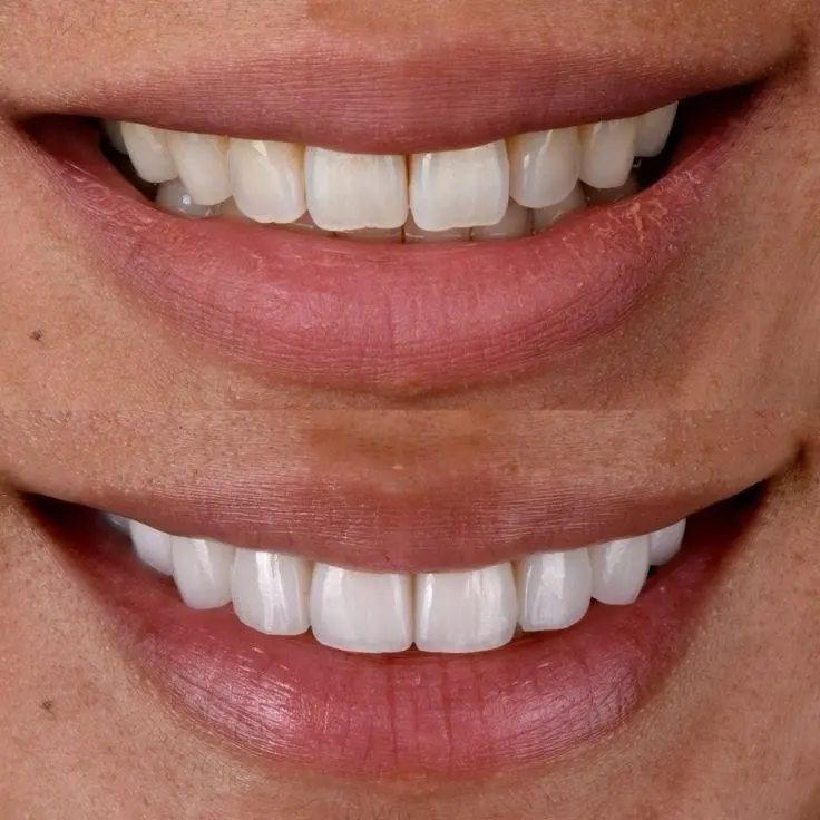 Sorriso de paciente antes e depois do tratamento