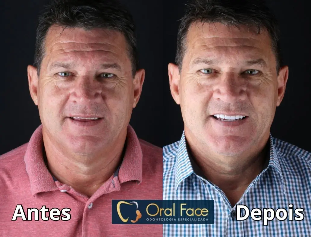 Sorriso de paciente antes e depois do tratamento