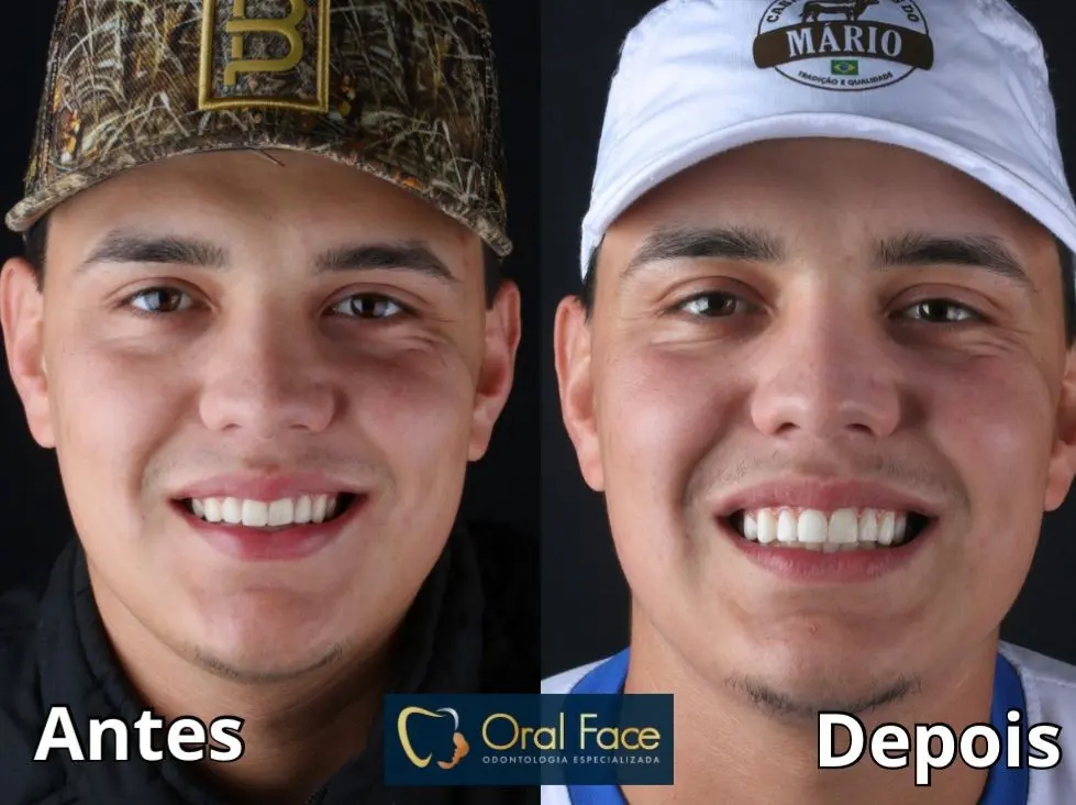 Sorriso de paciente antes e depois do tratamento