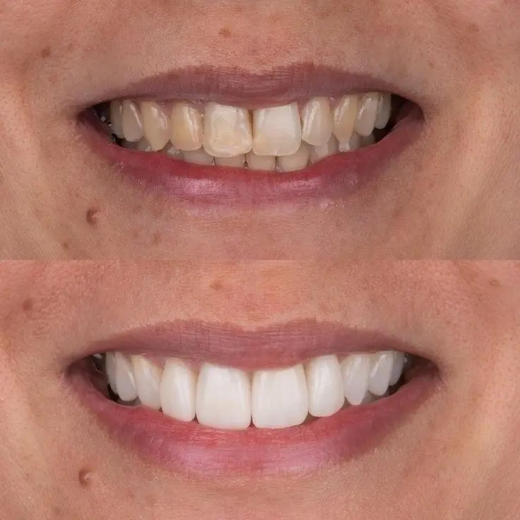 Sorriso de paciente antes e depois do tratamento