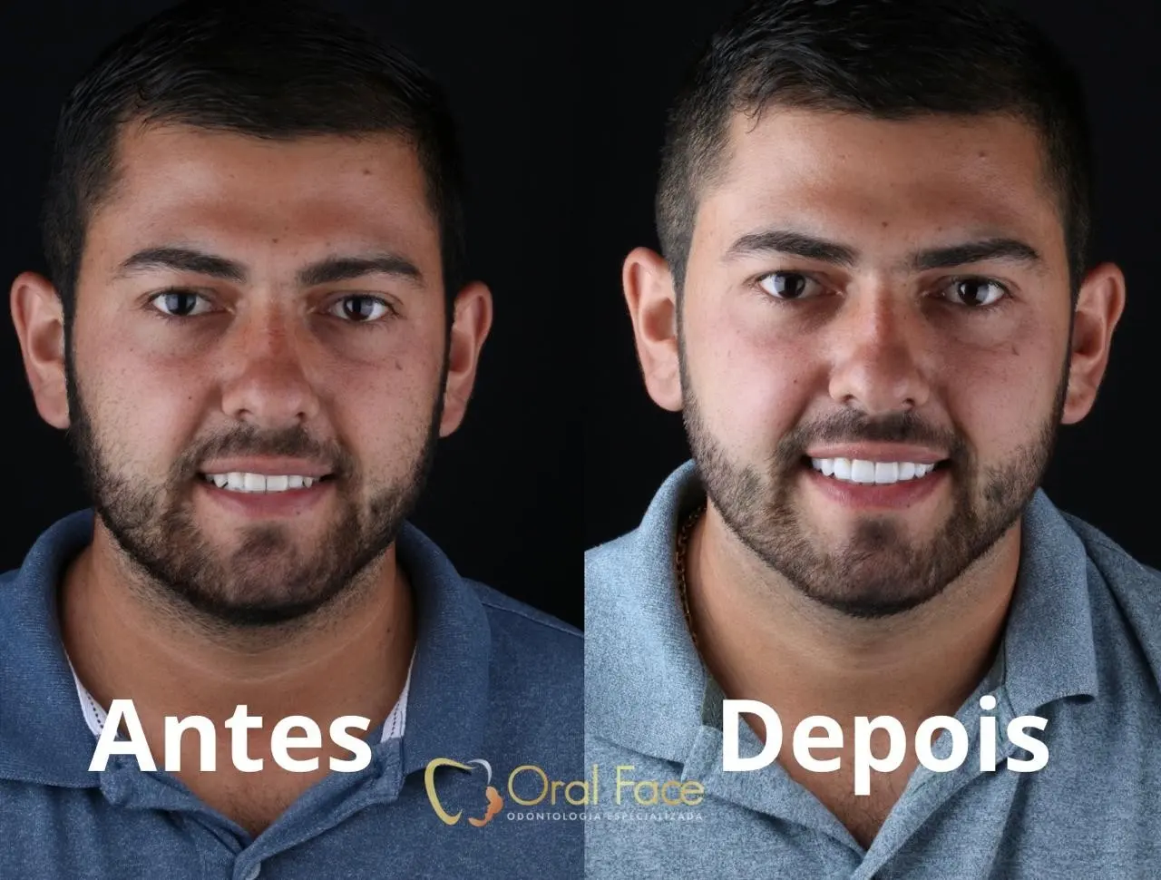 Sorriso de paciente antes e depois do tratamento