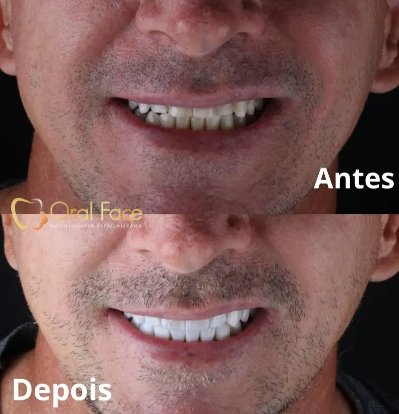 Sorriso de paciente antes e depois do tratamento