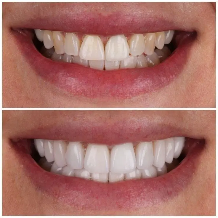 Sorriso de paciente antes e depois do tratamento
