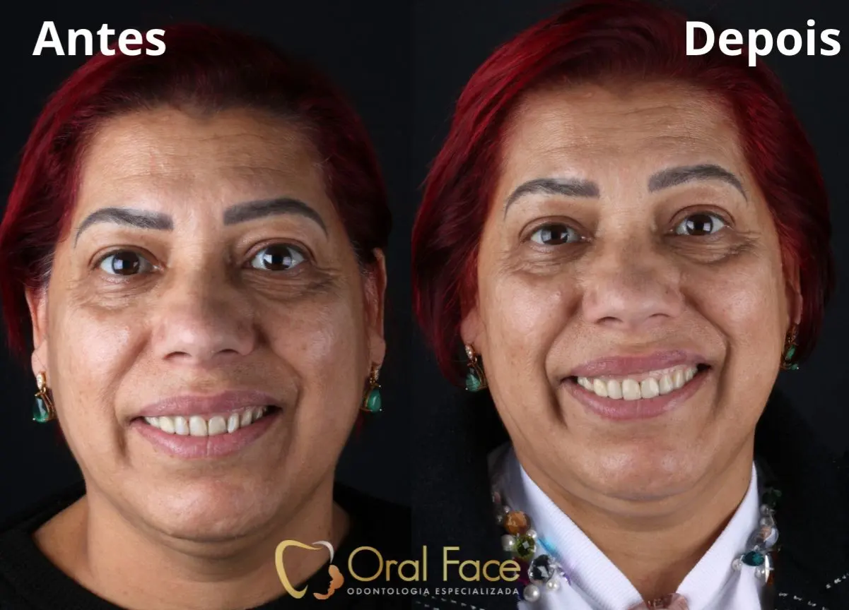 Sorriso de paciente antes e depois do tratamento