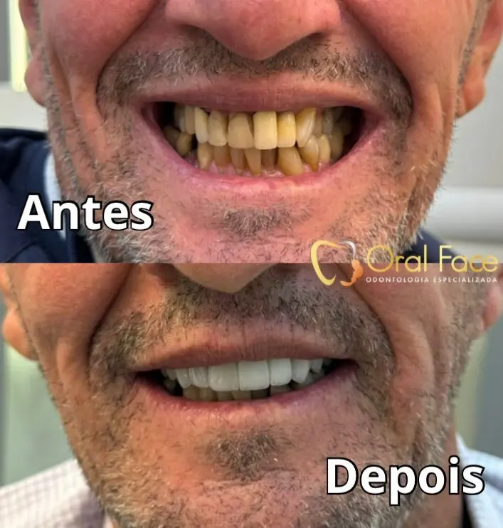 Sorriso de paciente antes e depois do tratamento