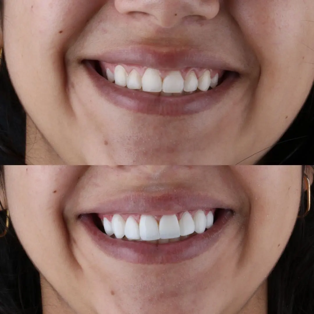 Sorriso de paciente antes e depois do tratamento