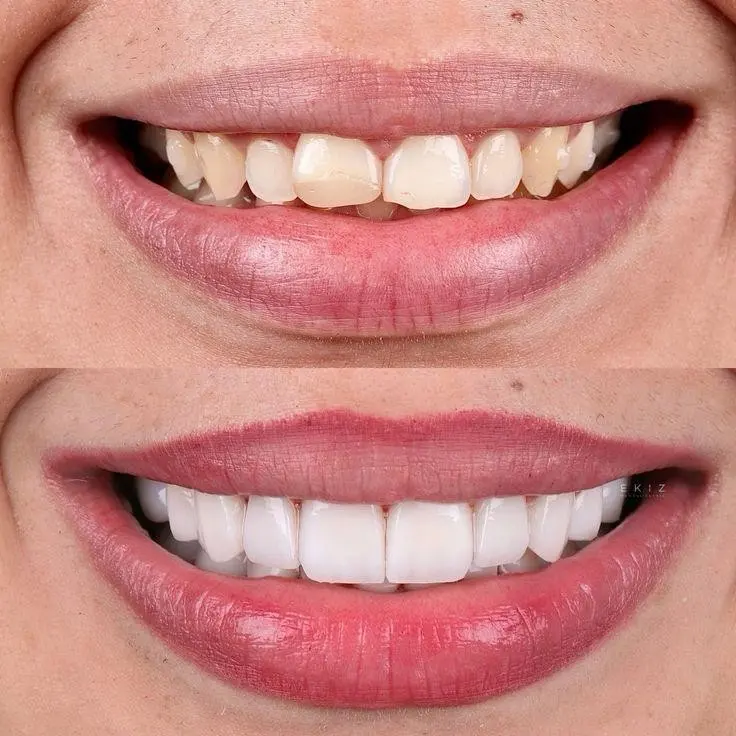 Sorriso de paciente antes e depois do tratamento