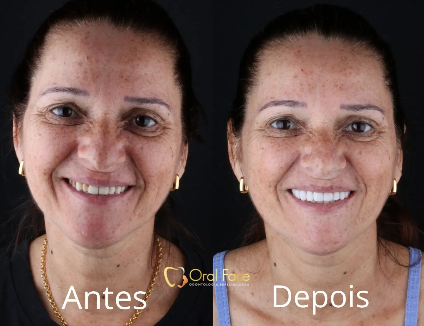 Sorriso de paciente antes e depois do tratamento