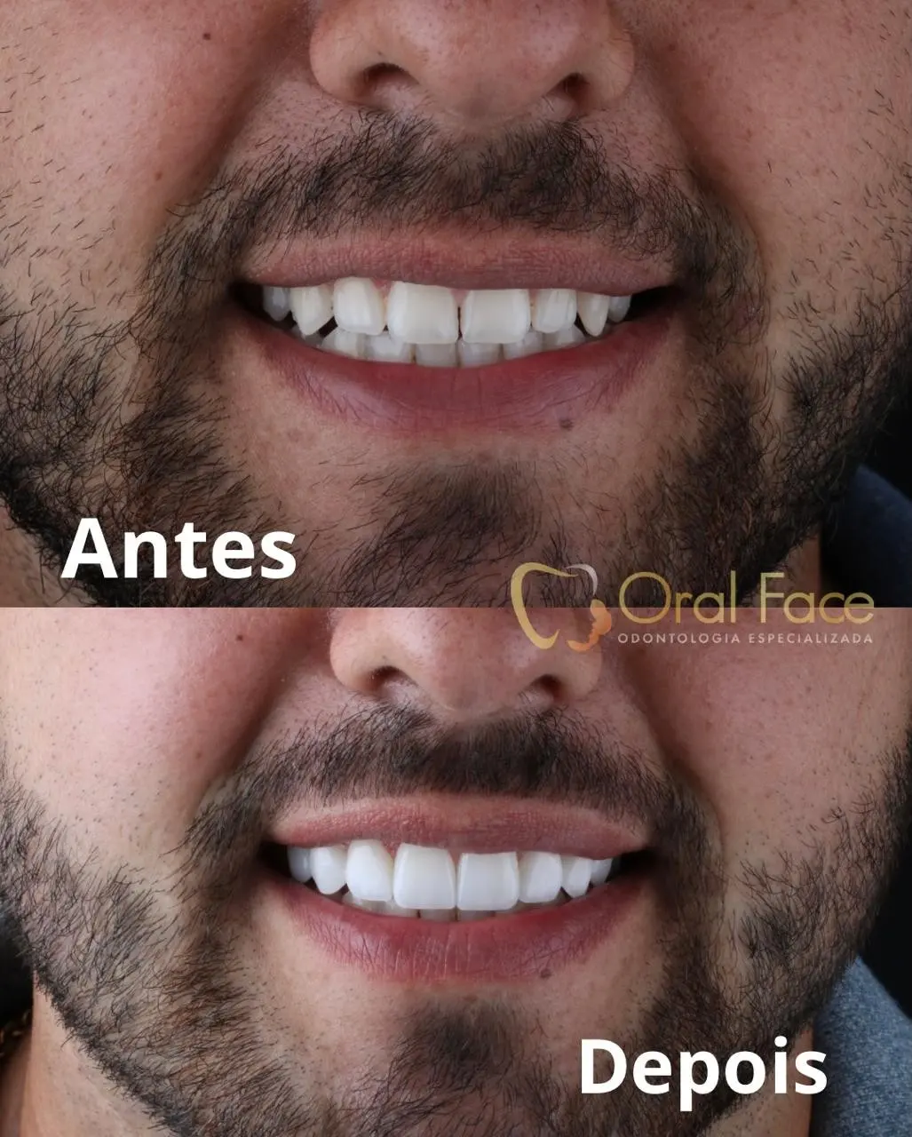 Sorriso de paciente antes e depois do tratamento